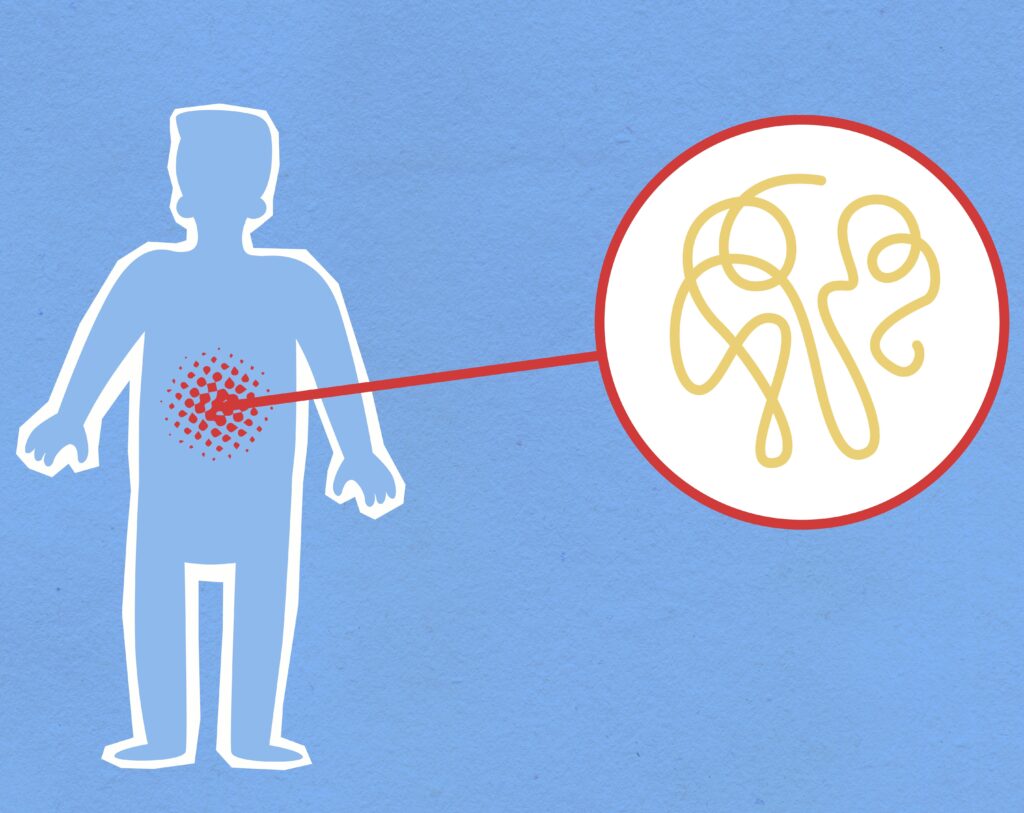 Crohn's conceptualization. Inflammatory bowel disease